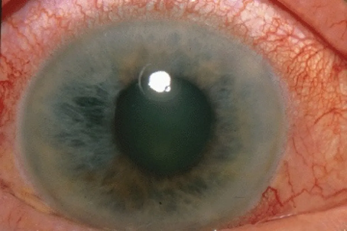 Ophtalmologie Rumilly
